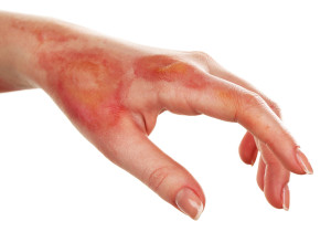 Contact a burn injury lawyer in your area today